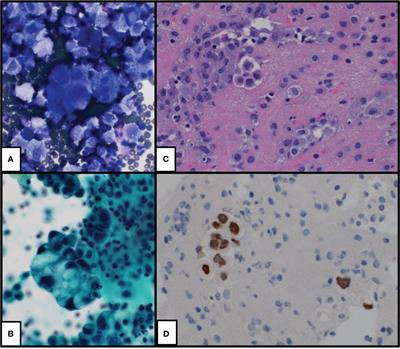 Lung adenocarcinoma in a patient with Lynch syndrome: a case report and literature review